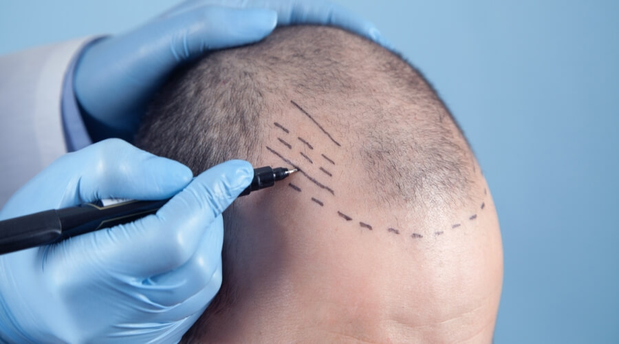 زراعة الشعر في السعودية