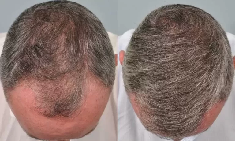 زراعة الشعر في جدة