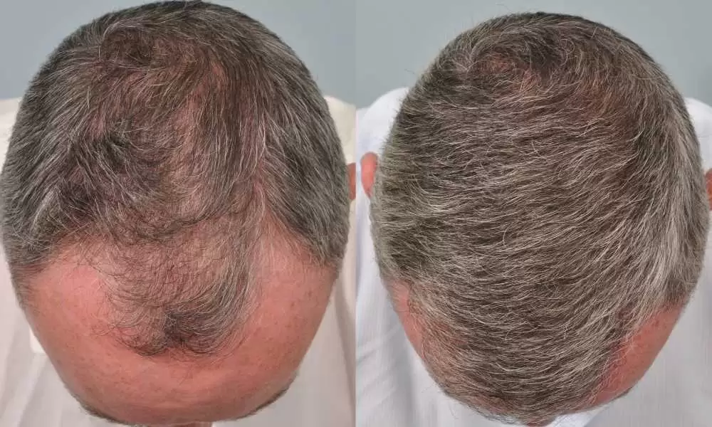 زراعة الشعر في جدة