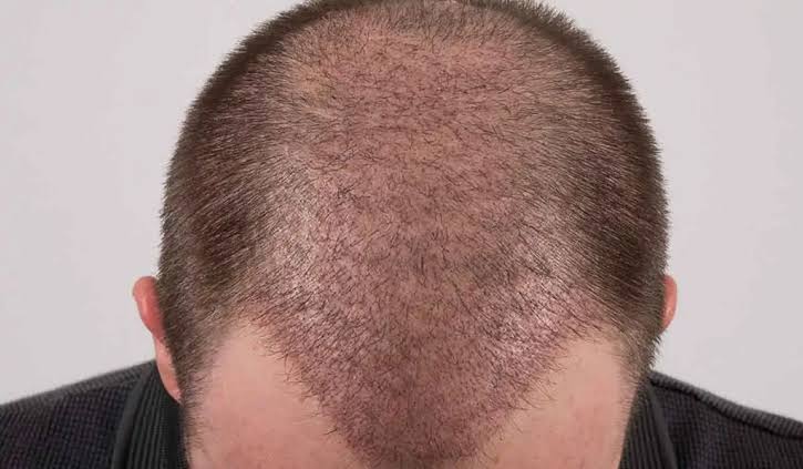 فترة التعافي والرعاية اللاحقة بعد زراعة الشعر في الكويت