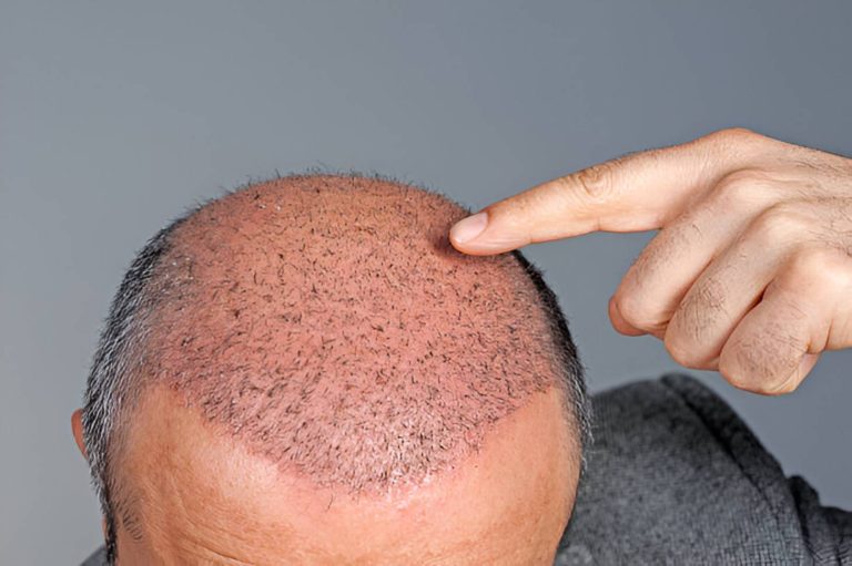 زراعة الشعر في الكويت